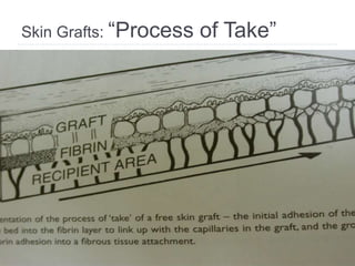 Skin Grafts: “Process of Take”
 