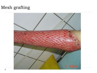 Mesh grafting
 