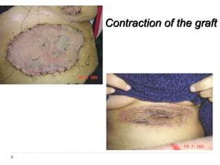 Contraction of the graft
 