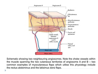 Schematic showing two neighbouring angiosomes. Note the choke vessels within
the muscle spanning the two cutaneous territories of angiosome A and B – two
common examples of myocutaneous flaps which utilise this physiology include
the rectus abdominus and the latisimus dorsi flaps.
 