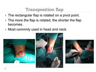 Transposition flap
 The rectangular flap is rotated on a pivot point.
 The more the flap is rotated, the shorter the flap
becomes.
 Most commnly used in head and neck
 