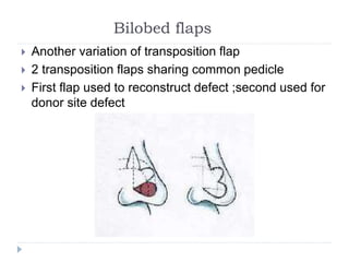 Bilobed flaps
 Another variation of transposition flap
 2 transposition flaps sharing common pedicle
 First flap used to reconstruct defect ;second used for
donor site defect
 