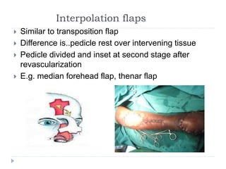 Interpolation flaps
 Similar to transposition flap
 Difference is..pedicle rest over intervening tissue
 Pedicle divided and inset at second stage after
revascularization
 E.g. median forehead flap, thenar flap
 