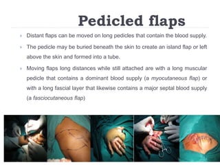 Pedicled flaps
 Distant flaps can be moved on long pedicles that contain the blood supply.
 The pedicle may be buried beneath the skin to create an island flap or left
above the skin and formed into a tube.
 Moving flaps long distances while still attached are with a long muscular
pedicle that contains a dominant blood supply (a myocutaneous flap) or
with a long fascial layer that likewise contains a major septal blood supply
(a fasciocutaneous flap)
 