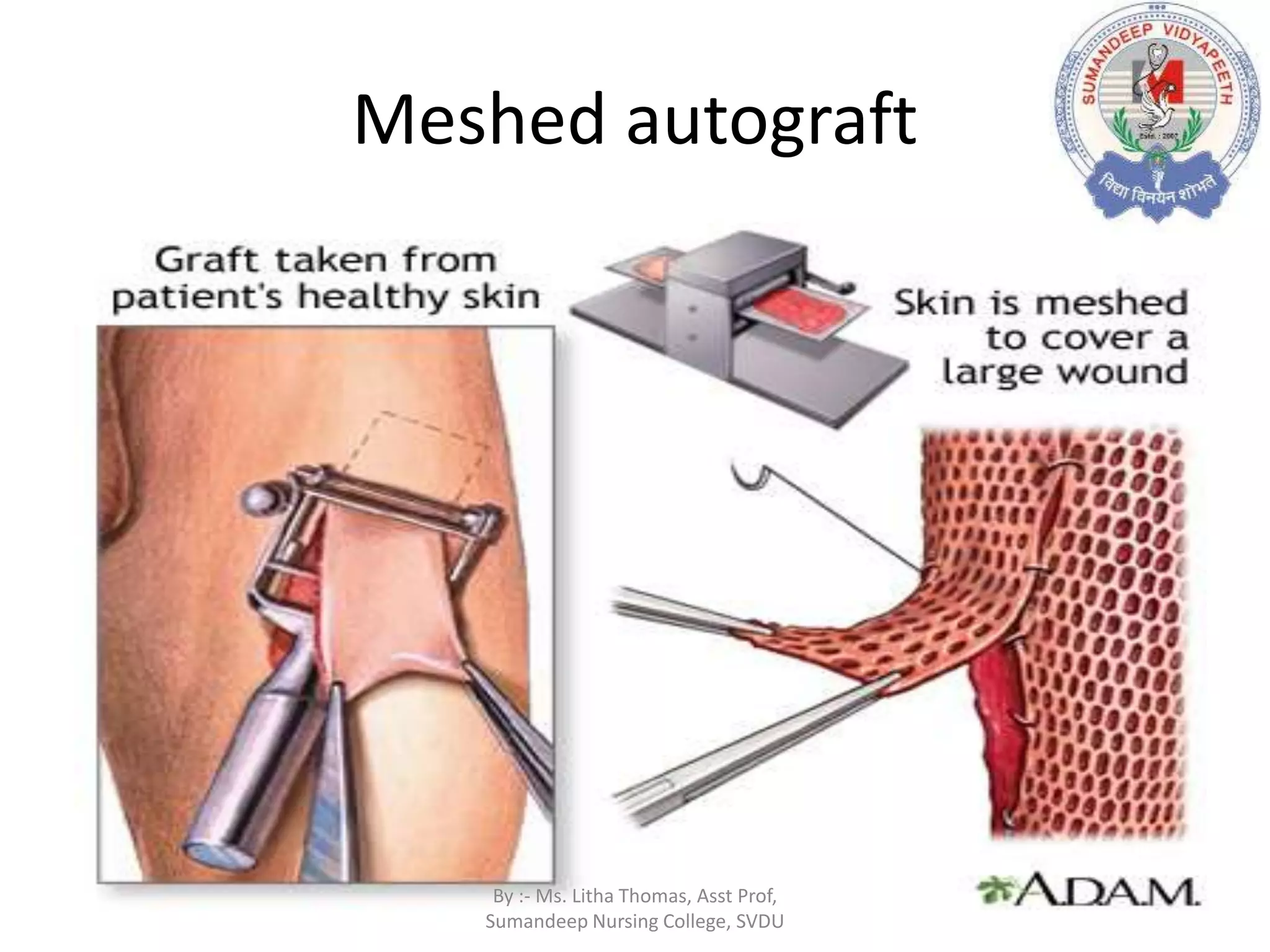 Meshed autograft
By :- Ms. Litha Thomas, Asst Prof,
Sumandeep Nursing College, SVDU
 