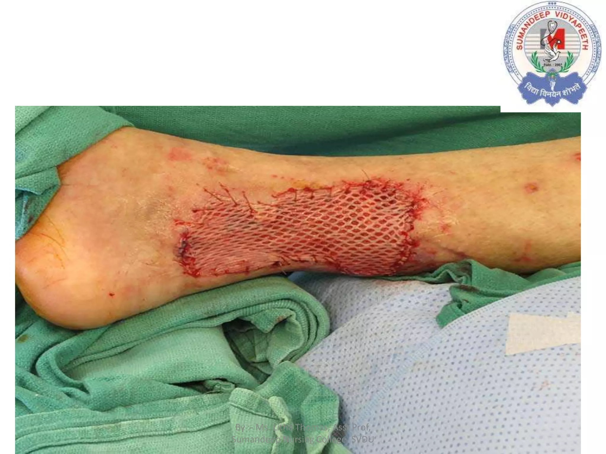 By :- Ms. Litha Thomas, Asst Prof,
Sumandeep Nursing College, SVDU
 