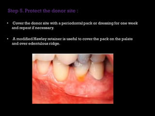 Pps Surgery Periodontal Plastic Surgery (PPS) is a branch of periodontics | PDF