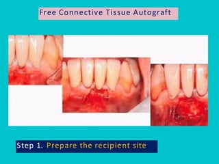 Pps Surgery Periodontal Plastic Surgery (PPS) is a branch of periodontics | PDF
