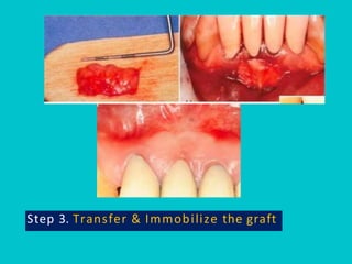 Pps Surgery Periodontal Plastic Surgery (PPS) is a branch of periodontics | PDF