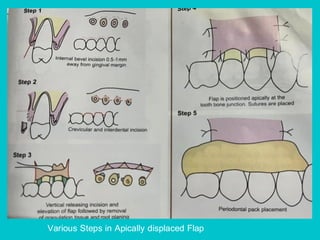 Pps Surgery Periodontal Plastic Surgery (PPS) is a branch of periodontics | PDF