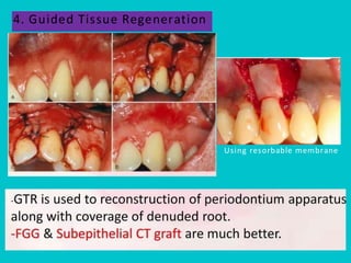 Pps Surgery Periodontal Plastic Surgery (PPS) is a branch of periodontics | PDF