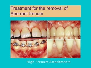 Pps Surgery Periodontal Plastic Surgery (PPS) is a branch of periodontics | PDF