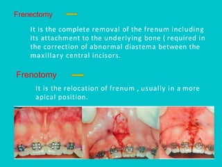 Pps Surgery Periodontal Plastic Surgery (PPS) is a branch of periodontics | PDF