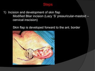 Preauricular Incision Steps Parotid Neoplasm | PPTX