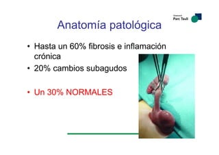 Anatomía patológica
• Hasta un 60% fibrosis e inflamación
crónica
• 20% cambios subagudos
• Un 30% NORMALES
 