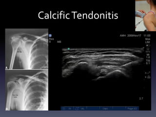 Study
•   Case-Control study design
•   485 patients with injection of cortisone or PRP for shoulder pain under ultrasound
    guidance
     – 186 Study patients / 299 Control patients


•   Results
     –   Statistical significance between groups for pain (mo 4-6) & ASES scores (mo 3-6)



•   Conclusion
     – PRP is as more effective than cortisone for relief of shoulder pain but with less risk
     – But varied based on diagnosis
 