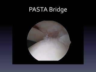 Pain Scores –
     Partial Patellar Tendon Tears
7.0          6.1
       5.9
6.0

5.0
                   3.6
4.0
                         2.9                                             3.2               3.3   3.3
                                                                               3.0   3.0
3.0                                                    2.7   2.6
                               2.3                                 2.4
                                     1.9         2.0
                                           1.7
2.0

1.0

 -




                                                                                           n = 12
 