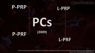 PCs
(2009)
P-PRP L-PRP
P-PRF
L-PRF
Dohan Ehrenfest DM, Rasmusson L, Albrektsson T. Classification of platelet concentrates: from pure platelet-rich plasma (P-PRP) to leucocyte- and platelet-rich
fibrin (L- PRF). Trends Biotechnol. 2009;27:158-167.
Classification
 