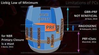 ANGIOGENESIS
PRIMARY
CLOSURE
PRF>Clots
Khorshidi, 2016
ANGIOGENIC
M Kobayashi, 2015
GBR+PRF
NOT BENEFICIAL
JS Yoon, 2014
for NBR
Primary Closure
is a must
E Borie, 2015
Limitations of PCs
 