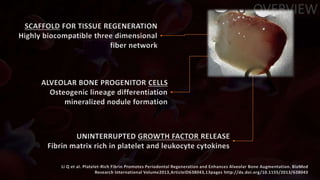 OVERVIEW
SCAFFOLD FOR TISSUE REGENERATION
Highly biocompatible three dimensional
fiber network
ALVEOLAR BONE PROGENITOR CELLS
Osteogenic lineage differentiation
mineralized nodule formation
UNINTERRUPTED GROWTH FACTOR RELEASE
Fibrin matrix rich in platelet and leukocyte cytokines
Li Q et al. Platelet-Rich Fibrin Promotes Periodontal Regeneration and Enhances Alveolar Bone Augmentation. BioMed
Research International Volume2013,ArticleID638043,13pages http://dx.doi.org/10.1155/2013/638043
 
