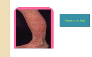 Purpura on legs
 