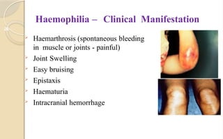 26
Haemophilia – Clinical Manifestation
 Haemarthrosis (spontaneous bleeding
in muscle or joints - painful)
 Joint Swelling
 Easy bruising
 Epistaxis
 Haematuria
 Intracranial hemorrhage
 