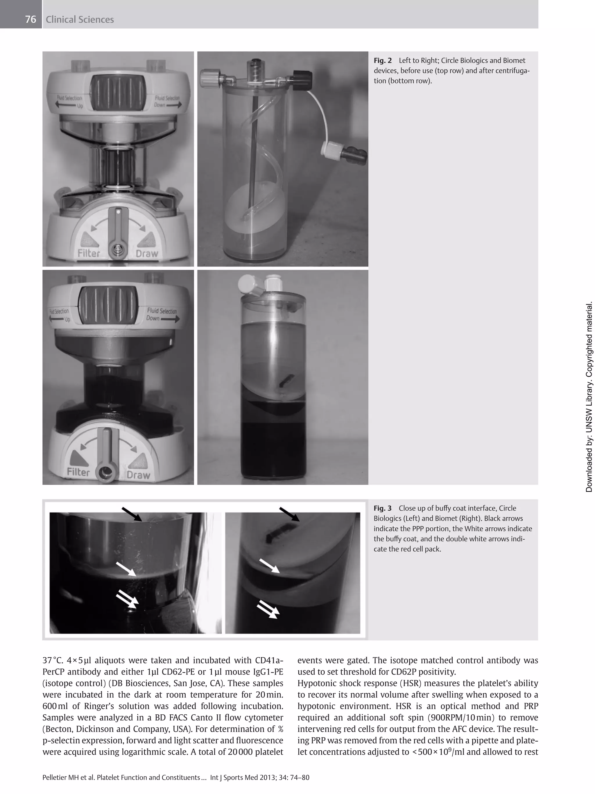 76 Clinical Sciences

Downloaded by: UNSW Library. Copyrighted material.

Fig. 2 Left to Right; Circle Biologics and Biomet
devices, before use (top row) and after centrifugation (bottom row).

Fig. 3 Close up of buﬀy coat interface, Circle
Biologics (Left) and Biomet (Right). Black arrows
indicate the PPP portion, the White arrows indicate
the buﬀy coat, and the double white arrows indicate the red cell pack.

37 °C. 4 × 5 μl aliquots were taken and incubated with CD41aPerCP antibody and either 1μl CD62-PE or 1 μl mouse IgG1-PE
(isotope control) (DB Biosciences, San Jose, CA). These samples
were incubated in the dark at room temperature for 20 min.
600 ml of Ringer’s solution was added following incubation.
Samples were analyzed in a BD FACS Canto II ﬂow cytometer
(Becton, Dickinson and Company, USA). For determination of %
p-selectin expression, forward and light scatter and ﬂuorescence
were acquired using logarithmic scale. A total of 20 000 platelet

events were gated. The isotope matched control antibody was
used to set threshold for CD62P positivity.
Hypotonic shock response (HSR) measures the platelet’s ability
to recover its normal volume after swelling when exposed to a
hypotonic environment. HSR is an optical method and PRP
required an additional soft spin (900RPM/10 min) to remove
intervening red cells for output from the AFC device. The resulting PRP was removed from the red cells with a pipette and platelet concentrations adjusted to < 500 × 109/ml and allowed to rest

Pelletier MH et al. Platelet Function and Constituents … Int J Sports Med 2013; 34: 74–80

 