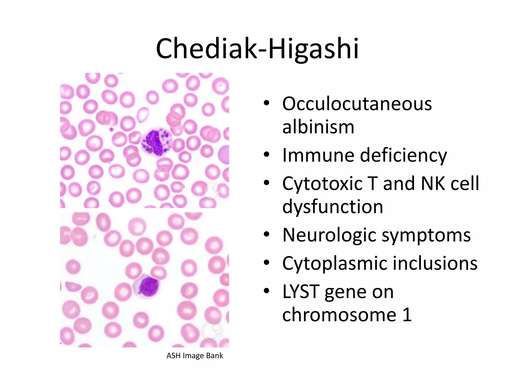 Chediak-Higashi
• Occulocutaneous
albinism
• Immune deficiency
• Cytotoxic T and NK cell
dysfunction
• Neurologic symptoms
• Cytoplasmic inclusions
• LYST gene on
chromosome 1
ASH Image Bank

 
