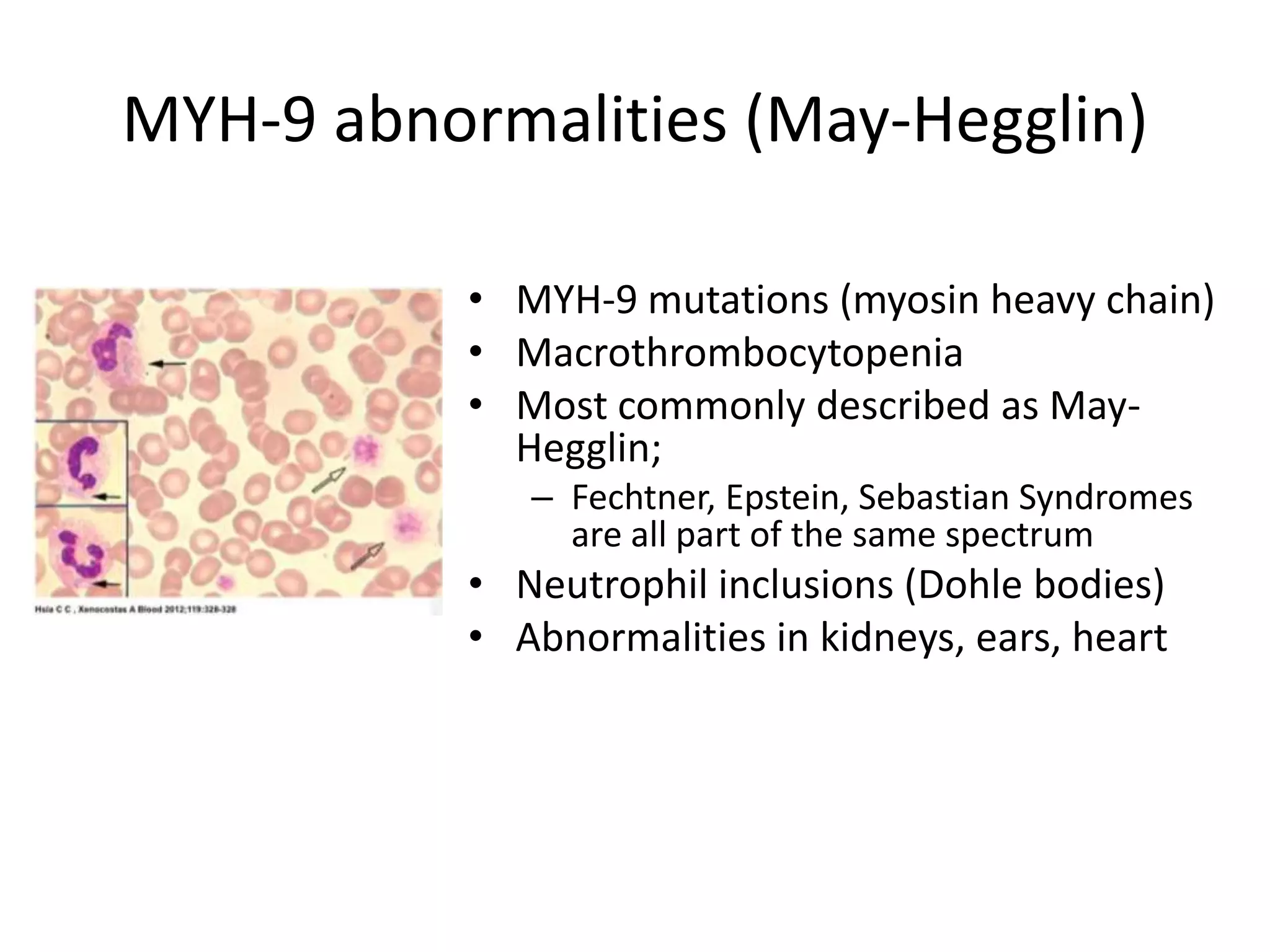 MYH-9 abnormalities (May-Hegglin)
• MYH-9 mutations (myosin heavy chain)
• Macrothrombocytopenia
• Most commonly described as MayHegglin;
– Fechtner, Epstein, Sebastian Syndromes
are all part of the same spectrum

• Neutrophil inclusions (Dohle bodies)
• Abnormalities in kidneys, ears, heart

 