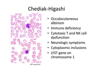 Chediak-Higashi
• Occulocutaneous
albinism
• Immune deficiency
• Cytotoxic T and NK cell
dysfunction
• Neurologic symptoms
• Cytoplasmic inclusions
• LYST gene on
chromosome 1
ASH Image Bank

 