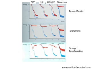 ADP

Epi

Collagen Ristocetan

Bernard Soulier

Glanzmann

Storage
Pool/Secretion

www.practical-hemostasis.com

 