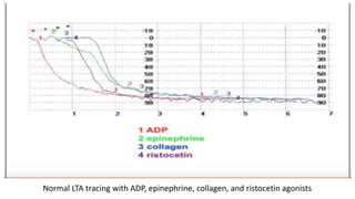 Normal LTA tracing with ADP, epinephrine, collagen, and ristocetin agonists
 