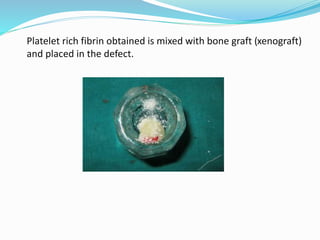 Platelet rich fibrin | PPTX