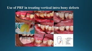 Prf Rgn Platelet-rich fibrin (PRF) or leukocyte- and platelet-rich fibrin (L ...