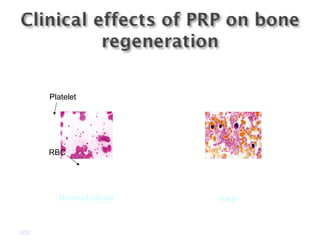 GDC
Platelet
RBC
Normal blood PRP
 