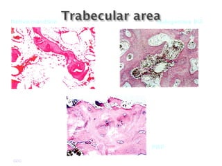 GDC
Native mandible Autogenous BG
PRP
 