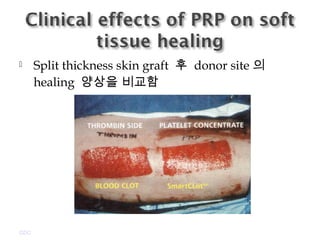  Split thickness skin graft 후 donor site 의
healing 양상을 비교함
GDC
 