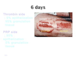 GDC
Thrombin side
: 5% epithelization
95% granulation
tissue
PRP side
; 95%
epithelization
5% granulation
tissue
 