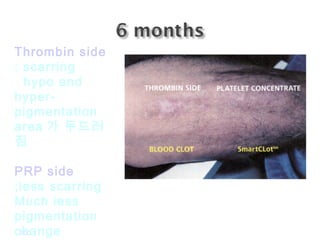 GDC
Thrombin side
: scarring
hypo and
hyper-
pigmentation
area 가 두드러
짐
PRP side
;less scarring
Much less
pigmentation
change
 