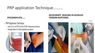 PRP application Technique.........
EPICONDYLITIS.....
ACCELERATE HEALING IN ACHILLES
TENDON RUPTURES
 