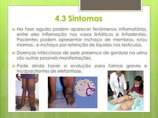 4.3 Sintomas
 Na fase aguda podem aparecer fenômenos inflamatórios,
entre eles inflamação nos vasos linfáticos e linfadenites.
Pacientes podem apresentar inchaço de membros, e/ou
mamas , e inchaço por retenção de líquidos nos testículos.
 Doenças infecciosas de pele presença de gordura na urina
são outras possíveis manifestações.
 Pode ainda haver a evolução para formas graves e
incapacitantes de elefantíase.
 