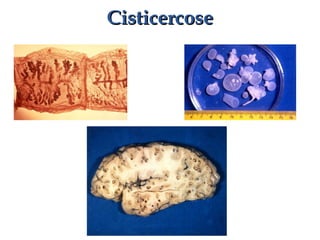CisticercoseCisticercose
 