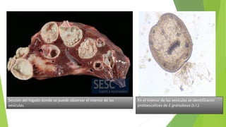 Sección del hígado donde se puede observar el interior de las
vesículas.
En el interior de las vesículas se identificaron
protoescolices de E.granulosus (s.l.).
 