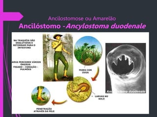 Ancilostomose ou Amarelão
Ancilóstomo -Ancylostoma duodenale
 
