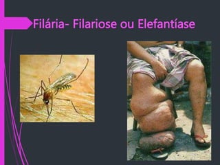 Filária- Filariose ou Elefantíase
 