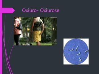 Oxiúro- Oxiurose
 