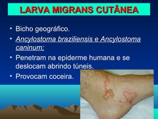 LARVA MIGRANS CUTÂNEA
• Bicho geográfico.
• Ancylostoma braziliensis e Ancylostoma
caninum;
• Penetram na epiderme humana e se
deslocam abrindo túneis.
• Provocam coceira.

 