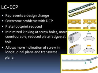 LC-DCP
 Represents a design change
 Overcome problems with DCP
 Plate footprint reduced
 Minimized kinking at screw ho...