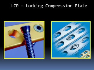 LCP – Locking Compression Plate
 