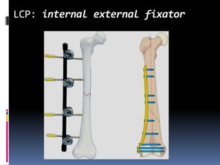 LCP: internal external fixator
 